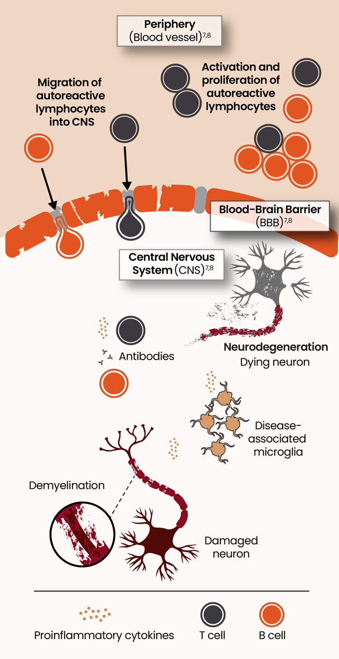 Illustration showing the pathophysiology of acute and smoldering neuroinflammation